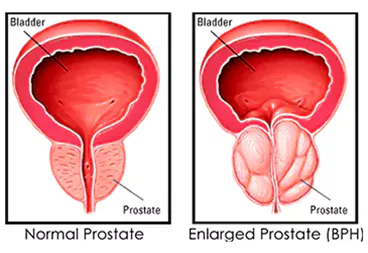 prostate